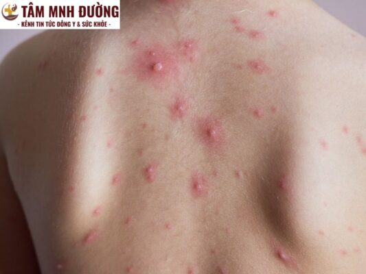 Bệnh thủy đậu ở người lớn có nhiều biến chứng nguy hiểm